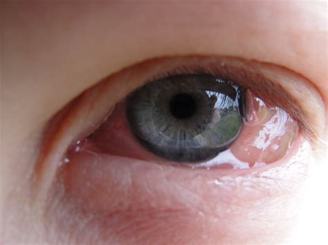 Carpenter's Colorful Collections: Dandelions=Allergic Conjunctivitis/Chemosis