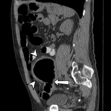 Image result for Colonic Diverticulum CT
