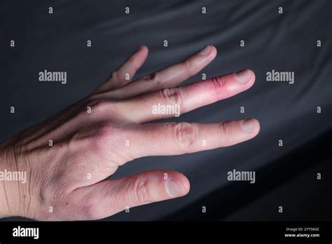 Splint Removal 的图像结果