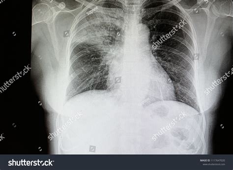 Chest X Ray Pneumonia