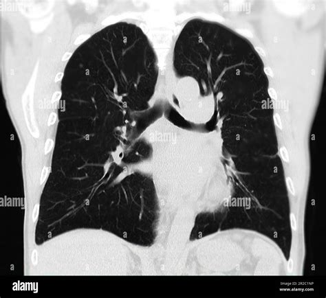 CT scan of Chest or lung for screening lung nodules and lung cancer ...