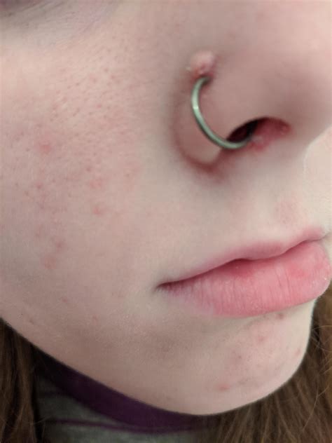 infection nose piercing