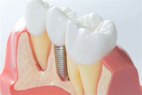 Is Bone Graft Necessary After Tooth Extraction? - Smile Credentials