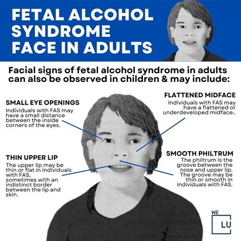 Fetal Alcohol Syndrome In Adults Symptoms, Facial Signs