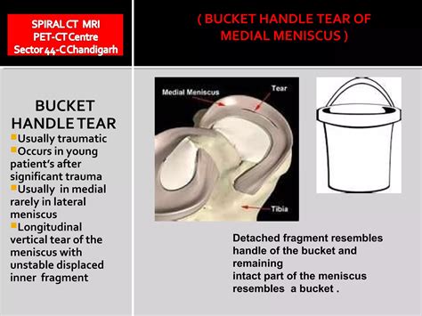 Bucket handle tear | PPT