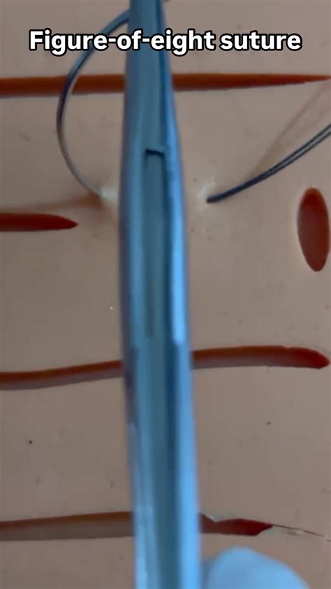 DR-A | figure-of-eight suture is a type of stitching used to close ...