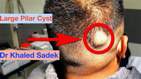 Massive 10 year Pilar Cyst comes out. Dr Khaled Sadek. 2309 - Pimple Community