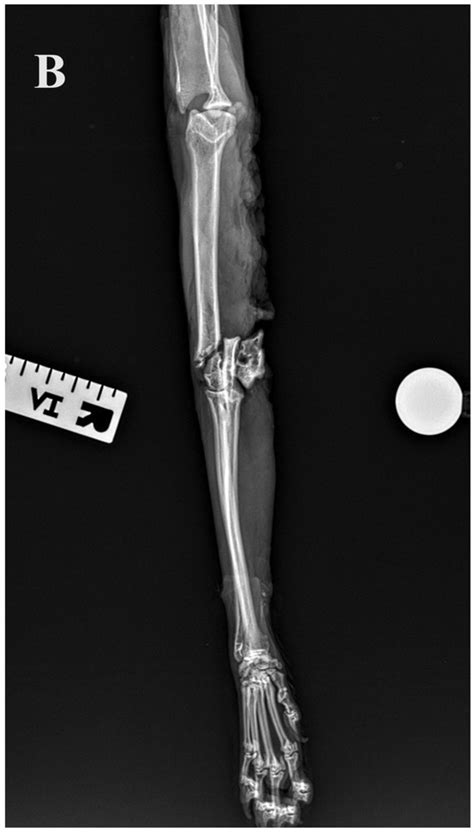 A 3D Printed Anatomically Pre-Contoured Plate for the Treatment of Y-T ...