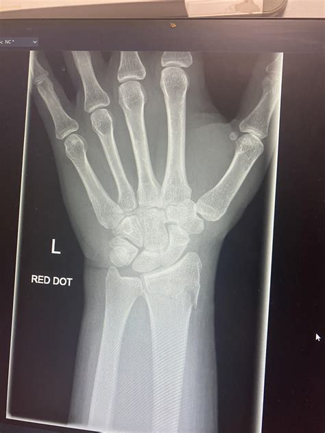 Would you get surgery for this wrist fracture? : r/brokenbones