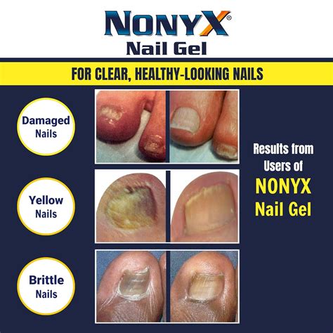 NONYX Fungal Nail Clarifying Gel | Clinically Proven India | Ubuy