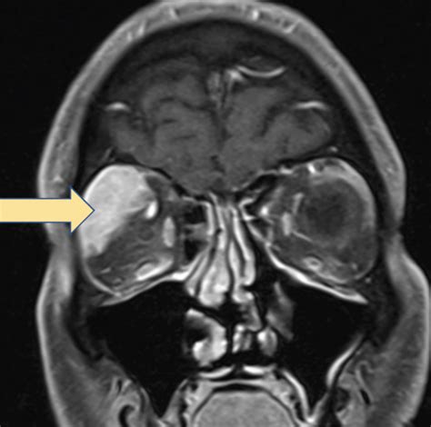 Swollen Lacrimal Gland Causes