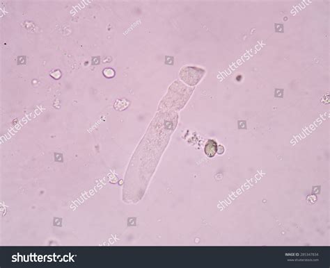 What Is Urn Hyaline Casts at Brooke Plume blog