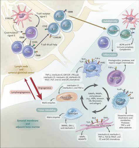 The Pathogenesis of Rheumatoid Arthritis | NEJM