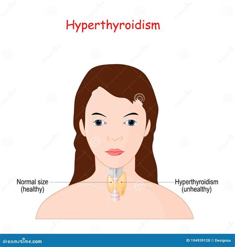 Normal Thyroid Size