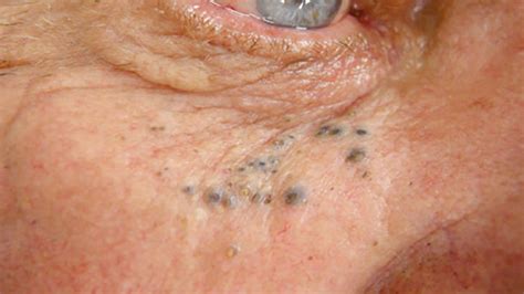 Image result for Solar Comedones Extraction