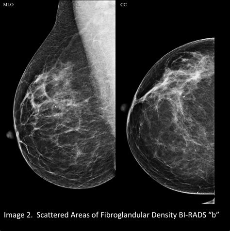 Are You Dense Breast Cancer at Cathy Remington blog