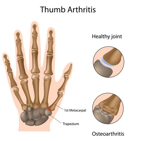 Joints Of Thumb Arthritis Of The Thumb | Bauerfeind New Zealand