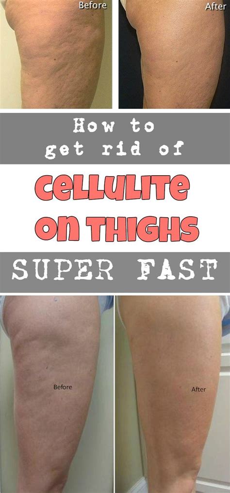 Image result for How to Remove Cellulite Fast