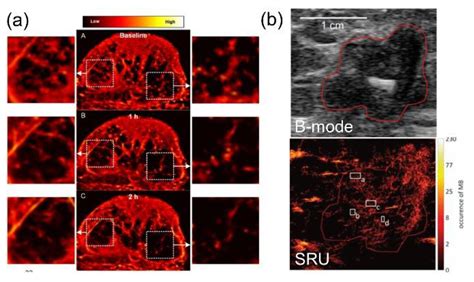Current Development and Applications of Super-Resolution Ultrasound Imaging