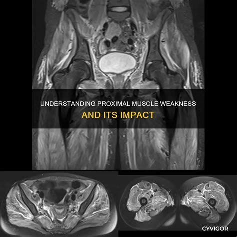 Understanding Proximal Muscle Weakness And Its Impact | CyVigor