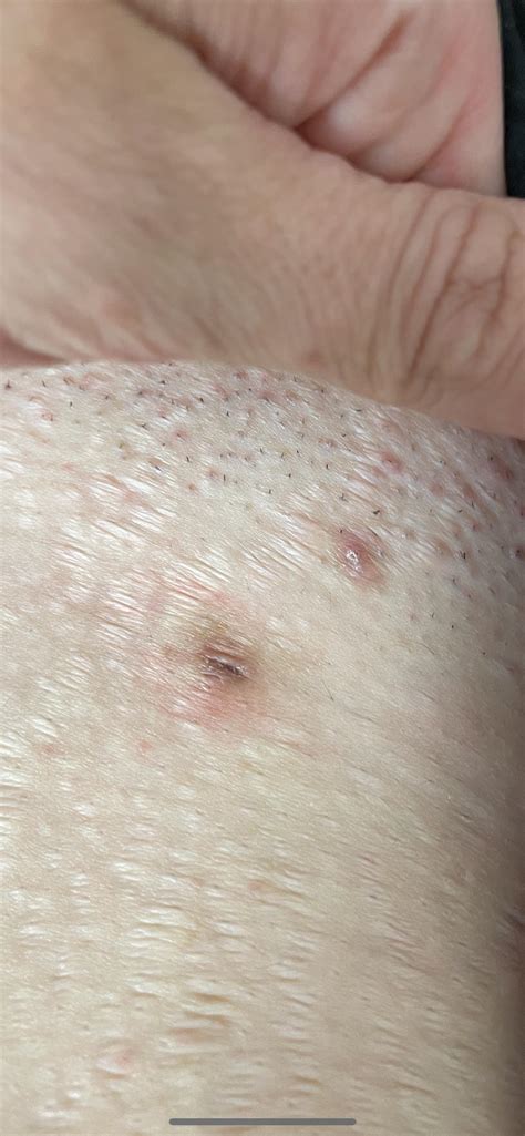 Bikini Line Ingrown Hair