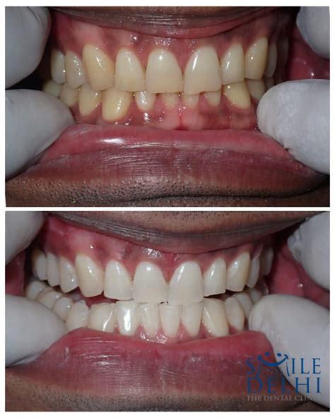 Zoom Teeth Whitening: Brighten Your Smile