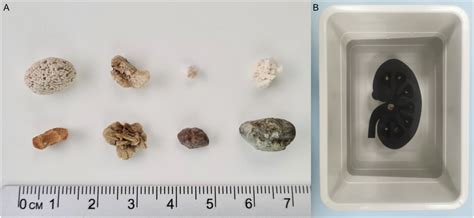 Kidney Stone Size Chart Kidney Stones: Symptoms, Diagnosis & Treatment