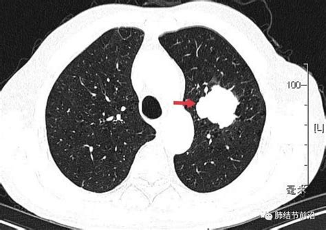 肺结节读片(13)：生长极快的小细胞肺癌结节|肺结节|吸烟史|肺气肿|肺癌|-健康界