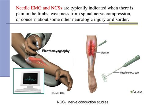 PPT - Electromyography (EMG) PowerPoint Presentation, free download - ID:1056729