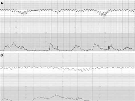 Pathophysiological interpretation of fetal heart rate tracings in ...