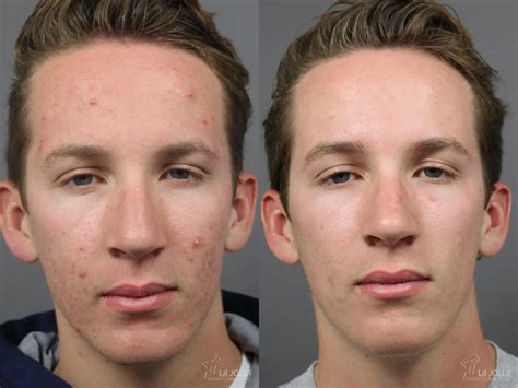 Acne: Laser Treatment Before & After Gallery