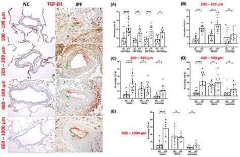 TGF-β1, pSmad-2/3, Smad-7, and β-Catenin Are Augmented in the Pulmonary ...