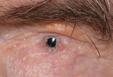 Corneal Transplant Before And After