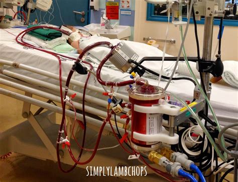 Image result for ECMO Procedure