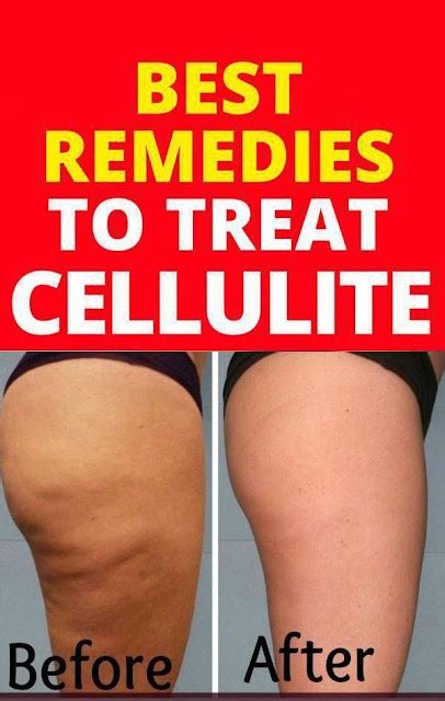 Image result for How to Remove Cellulite Fast