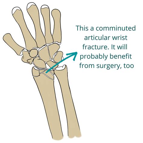 Classification Of Wrist Fractures at Joseph Dearth blog