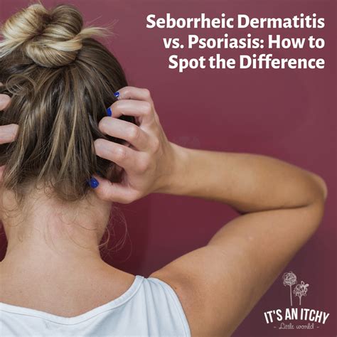 Psoriasis vs. Seborrheic Dermatitis: What's The Difference?