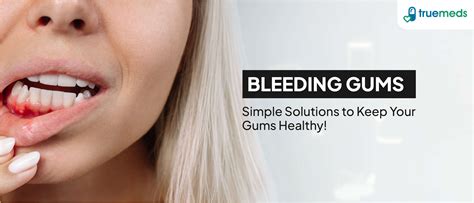 10 Best Home Remedies for Bleeding Gums | Truemeds
