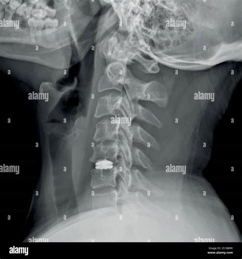 Neck X-ray of a patient undergoing Cervical Microdiscectomy and Cervical Disc Prosthesis for ... - neck x ray