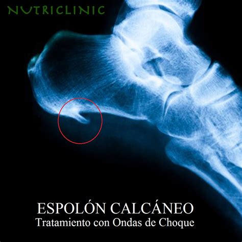 Qué Es El Espolón Calcáneo: Principales Causas Y Sus Tratamientos ...