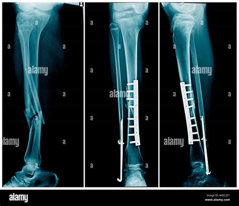 Fracture Of Tibia And Fibula High Resolution Stock Photography and ...