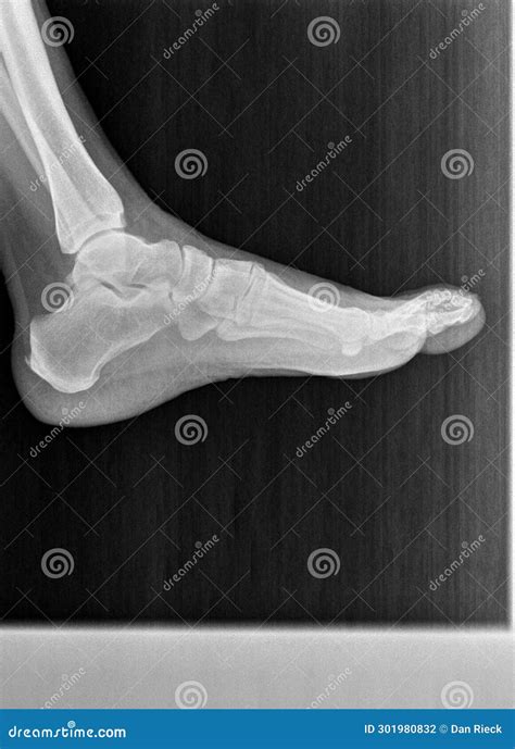 Film Xray or Radiograph of a Normal Foot, Ankle and Leg. Lateral View ...