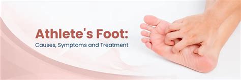 Pied d'athlète (Tinea pedis) : symptômes, causes et traitement