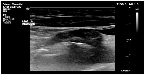 Gray-Scale Median in Patients with Symptomatic and Asymptomatic Carotid ...