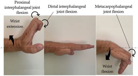 Flexion Extension Wrist Sprain at Brian Christensen blog