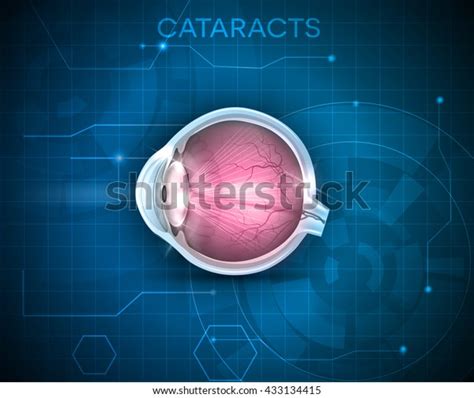 Vision Disorder 的图像结果