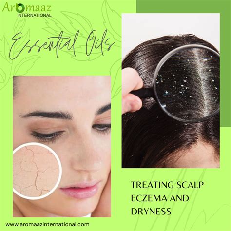 Essential Oils for Treating Dryness and Scalp Eczema - Aromaaz International - Medium