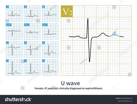 115 Ekg Wide Images, Stock Photos & Vectors | Shutterstock