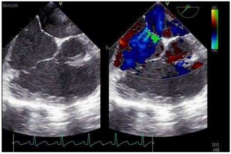PFO Defect 的图像结果