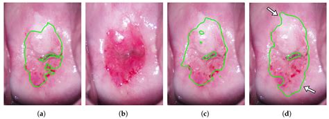 Diagnosis Assistance in Colposcopy by Segmenting Acetowhite Epithelium Using U-Net with Images ...